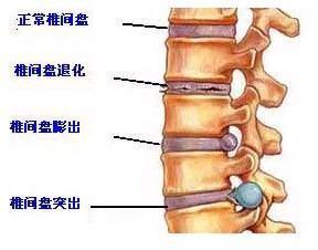 椎间盘突出头条号,揭秘病因、症状及防治策略